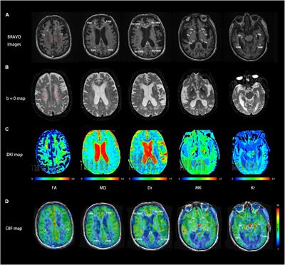 The Diagnostic Value of the Combined 3D Pseudo-Continuous Arterial Spin Labeling and Diffusion Kurtosis Imaging in Patients With Binswanger’s Disease